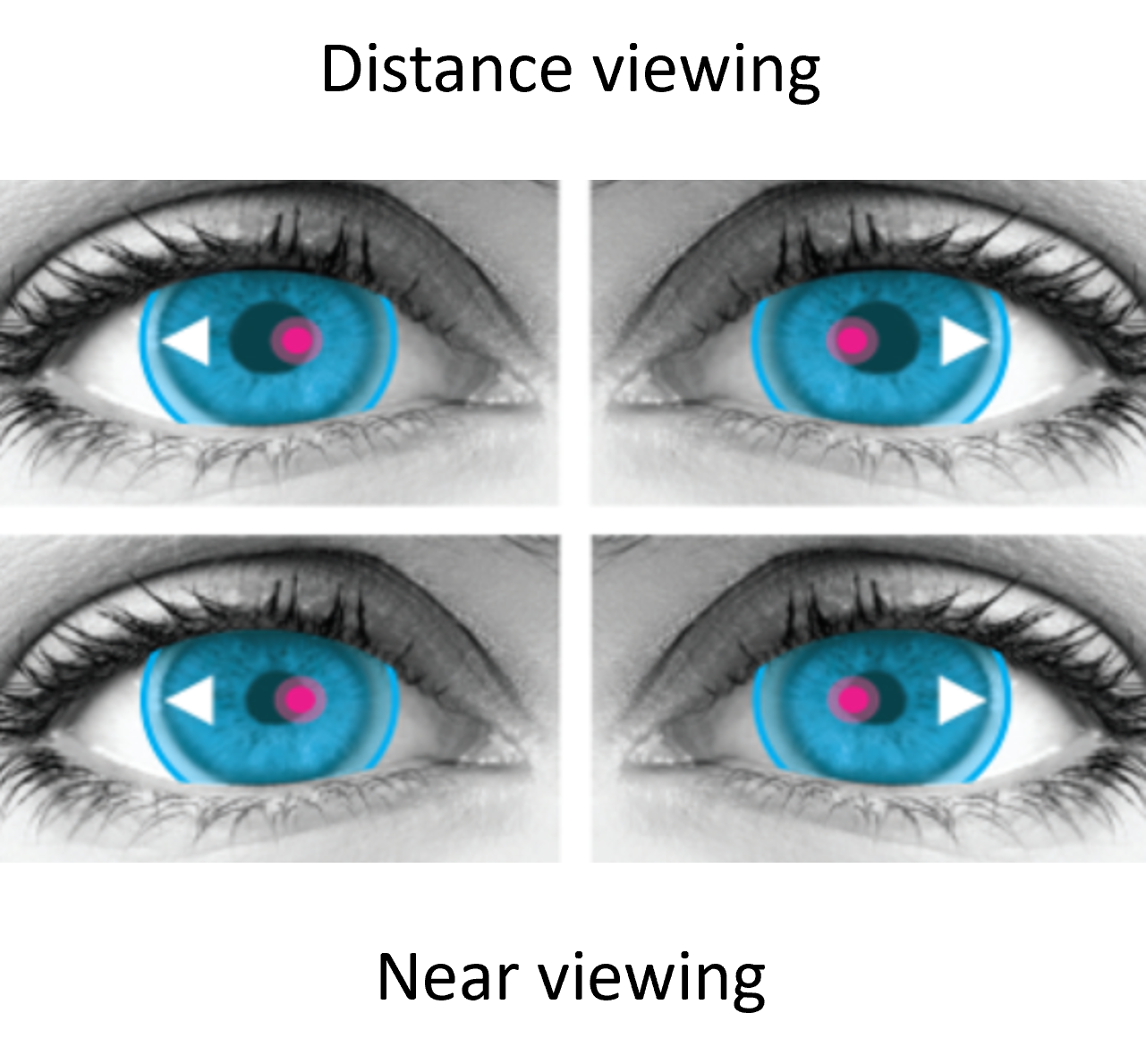 Miru 1month Mutifocal